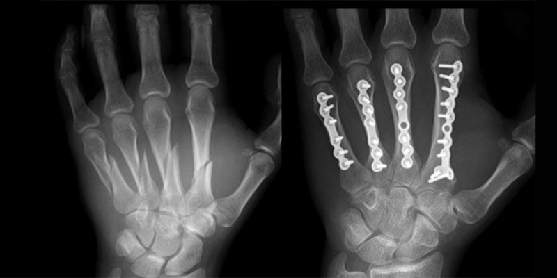Handchirurg Wien, Handchirurgie, Arzt für Handverletzungen